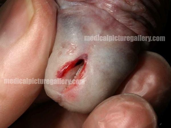 Balanitis xerotica obliterans