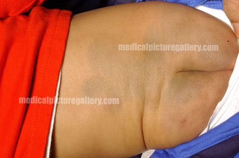 Congenital dermal melanocytosis