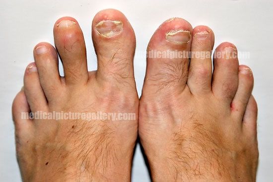 Psoriasis arthropatica