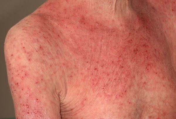 Eczemas miscellaneous